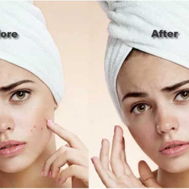 A better Healthy Acne Solutions for your skin