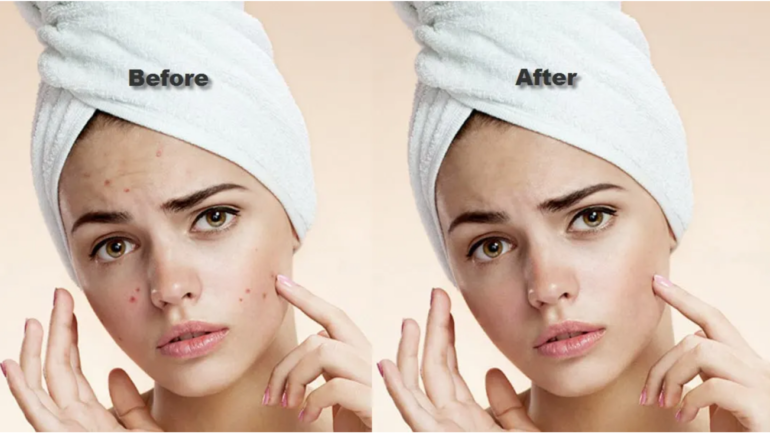 A better Healthy Acne Solutions for your skin